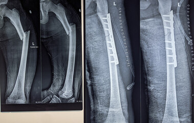 X ray image of femur fracture and fixation of the fracture by dynamic plate and screws 
