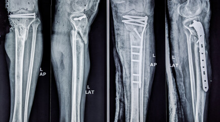 X ray of upper tibial fracture and fixation with dynamic plate and screws