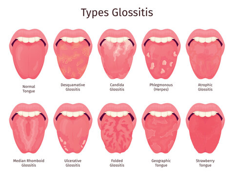 Glossitis. Scarlet tongue disease types, human mouth sore teeth problem healthy or sick xerostomia thrush atrophic candidiasis bacteria infections ulcera swanky illustration