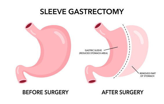 Vertical sleeve gastrectomy surgery medical vector illustration.