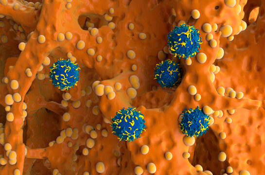 CAR T cell therapy in Bone tumor (cancer) - isometric view 3d illustration