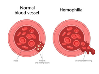 comparing a normal blood vessel with one affected by hemophilia, differences in clotting and bleeding diagram hand drawn schematic vector illustration. Medical science educational illustration