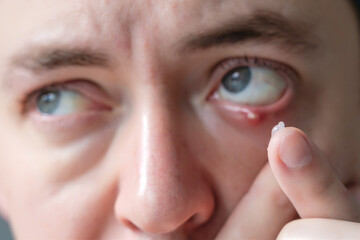Infected chalazion (stye, barley) or hordeolum eye on lower eyelid of man