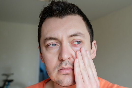 Infected chalazion (stye, barley) or hordeolum eye on lower eyelid of man