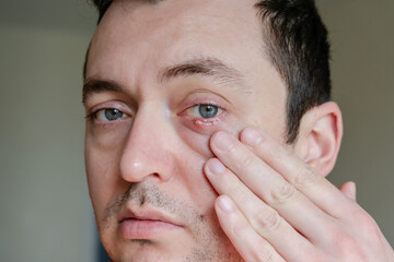 Obraz premium Infected chalazion (stye, barley) or hordeolum eye on lower eyelid of man