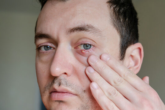 Infected chalazion (stye, barley) or hordeolum eye on lower eyelid of man