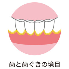 歯と歯ぐきの境目に溜まった歯垢　歯磨き　磨き残し