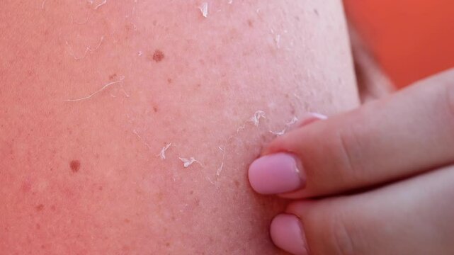 A woman peels skin off her shoulder with her fingers after a sunburn.