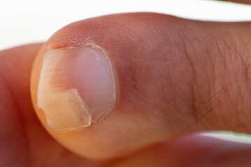 Set of toes where one of the nails is broken.