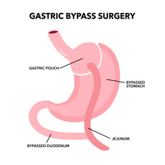 Gastric bypass gastroplasty operation. Obesity problem, weight loss procedure.