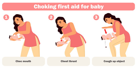 Choking first aid for baby infographic for mother education vector illustration. Heimlich maneuver rescue technique with correct subsequence for unblock infant kid breathing