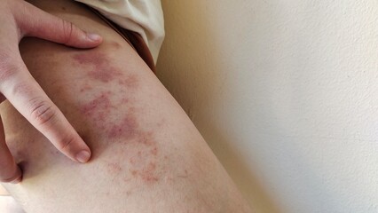 Fototapeta premium close up of a patient, rash hives allergy and inflammation skin, reaction and urticaria, scar and disease on the leg of the woman, health care and medical concept.