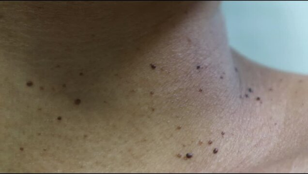Close up the skin tags on woman's neck. Acrochordon. Health care concept. Woman showing her neck's skin with skin tag.