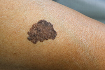 melanoma - a malignant tumor of the skin