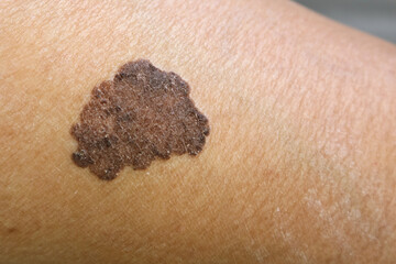 melanoma - a malignant tumor of the skin