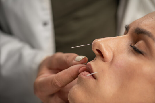 Acupuncturist inserting acupuncture needles into female patient nose to help quit smoking