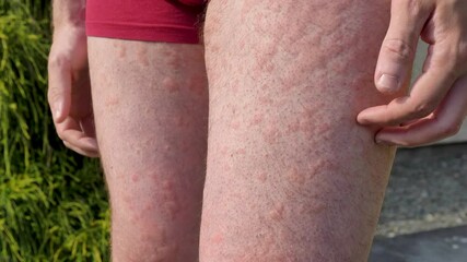 Itchy hives spreading across legs
