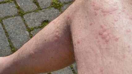 Close up of hives spreading across Caucasian man's legs