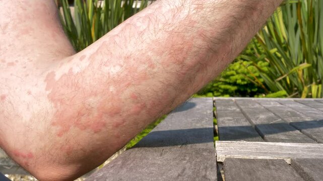 Man shows bad outbreak of hives on skin