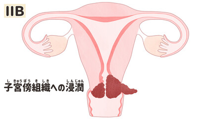Cervical cancer stage 2B diagram PNG