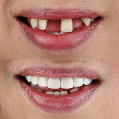 smile makeover porcelain laminated veneers result	