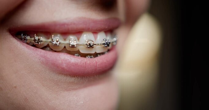 Dental Braces. Close up smile of woman with dental braces. Concept of orthodontic treatment, oral hygiene, and health care. Metal brackets on teeth and importance of maintaining oral care with braces