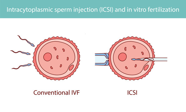 Intracytoplasmic sperm injection (ICSI) and in vitro fertilization hand drawn in line style