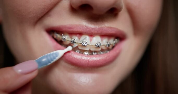 Close-up of woman cleaning dental braces with specialized brush. Oral hygiene and orthodontic care concept captured vividly, demonstrating meticulous dental care routine. Dental Braces.