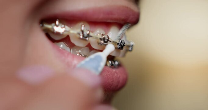 Close-up of a woman cleaning braces on teeth using an orthodontic toothbrush at home. Concept of oral hygiene and dental health care. Detailed view of metal brackets being cleaned. Dental Braces.