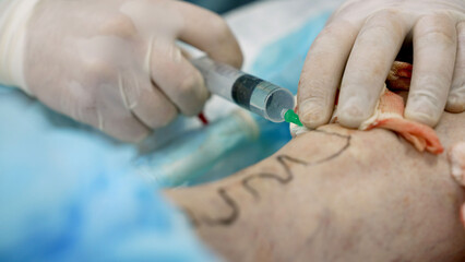 A doctor performs surgery on the veins of the legs, close-up. Close-up of surgery on a patient's leg to remove varicose veins.