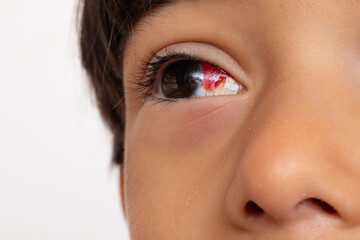 Young boy suffering from subconjunctival hemorrhage in eye
