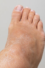 Dry skin showing signs of severe dehydration on foot