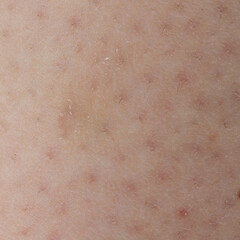 Fototapeta premium Close up of human skin showing keratosis pilaris