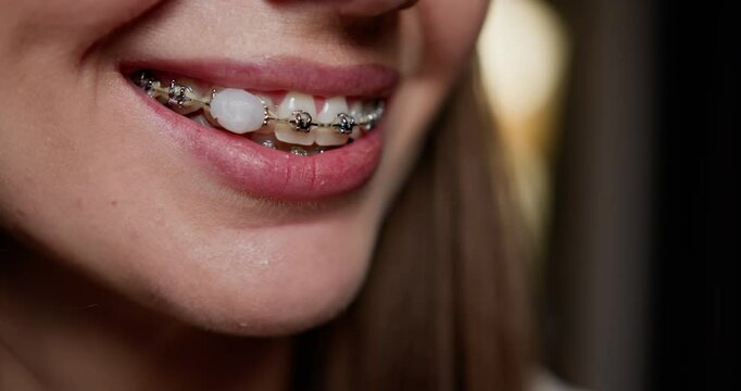 Close-up of young woman showing dental braces emphasizing orthodontic treatment. Concept of dental health, oral hygiene and self-esteem. Focus on woman's mouth and braces. Wax for teeth or braces.