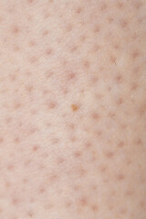 Skin showing folliculitis inflammation epidermis dermatology allergy