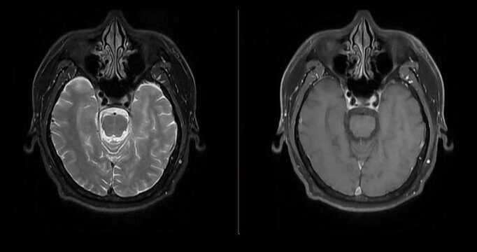 The video of an MRI neck T2 and T2FS demonstrates modern technology in detecting head and neck diseases.