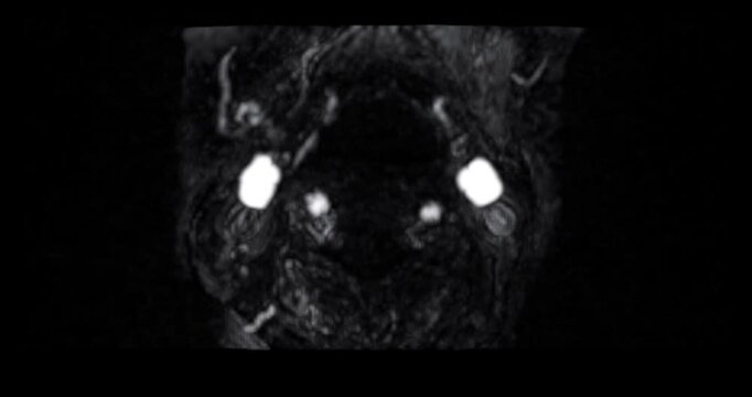 MRA Brain or Magnetic resonance angiography of Cerebral artery  for evaluate cerebral artery.
