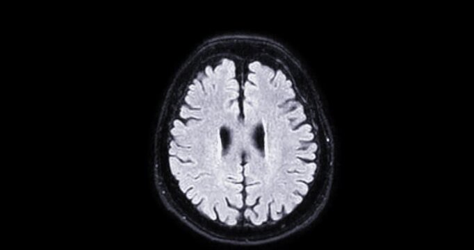 The MRI brainT2 flair sequence  scan footage reveals intricate brain details, aiding in diagnostic procedures.