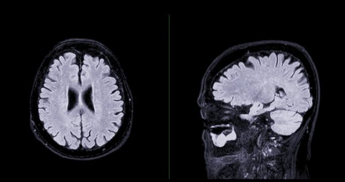 The MRI brainT2 flair sequence  scan footage reveals intricate brain details, aiding in diagnostic procedures.