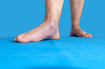 Várices en pies de mujer mayor de 60 años. Arañitas vasculares. Insuficiencia venosa. Tratamiento.  