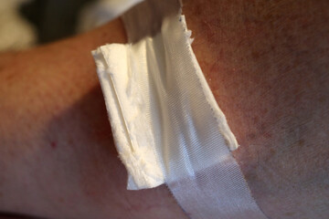Sterile gauze pad taped to the skin with medical adhesive tape after an injection or blood collection