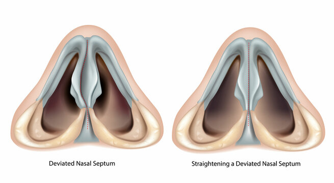 Deviated nasal septum and Straightening a Deviated Nasal Septum.  Septoplasty and Rhinoplasty