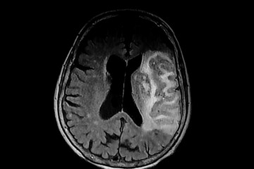 Medical themes: Tomography of Cerebral hemorrhage in the territory of the left middle cerebral artery