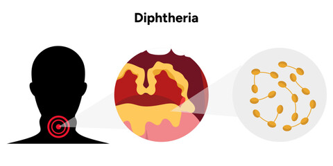 Diphtheria medical diagram with human illustration throat zoom and bacterial 