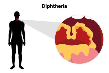 Diphtheria medical information with human illustration and throat zoom 