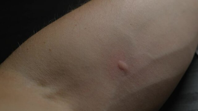 Pimple from a mosquito bite on a man's hand, close-up