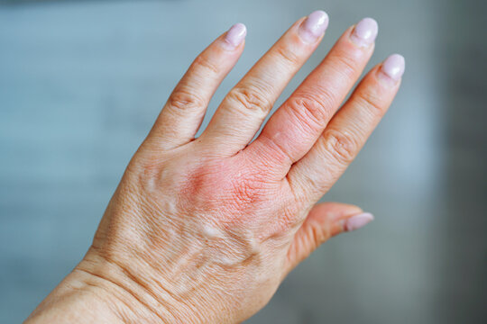 hand swollen from wasp sting