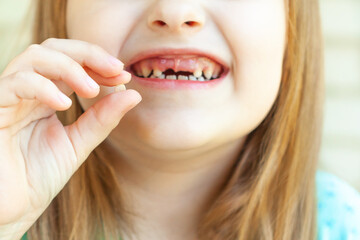 Close-up of girl's smile without two front teeth, holding lost baby tooth in her hand. Growing up children, pediatric dentistry, changing baby teeth to permanent concept.
