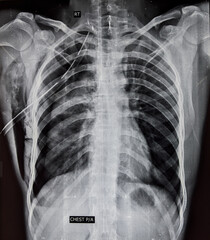 Chest x ray showing chest drain tube in lung, used to treat pneumothorax 