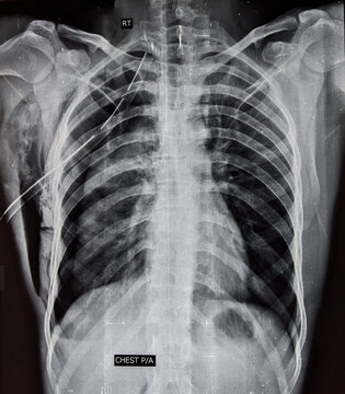 Chest x ray showing chest drain tube in lung, used to treat pneumothorax 